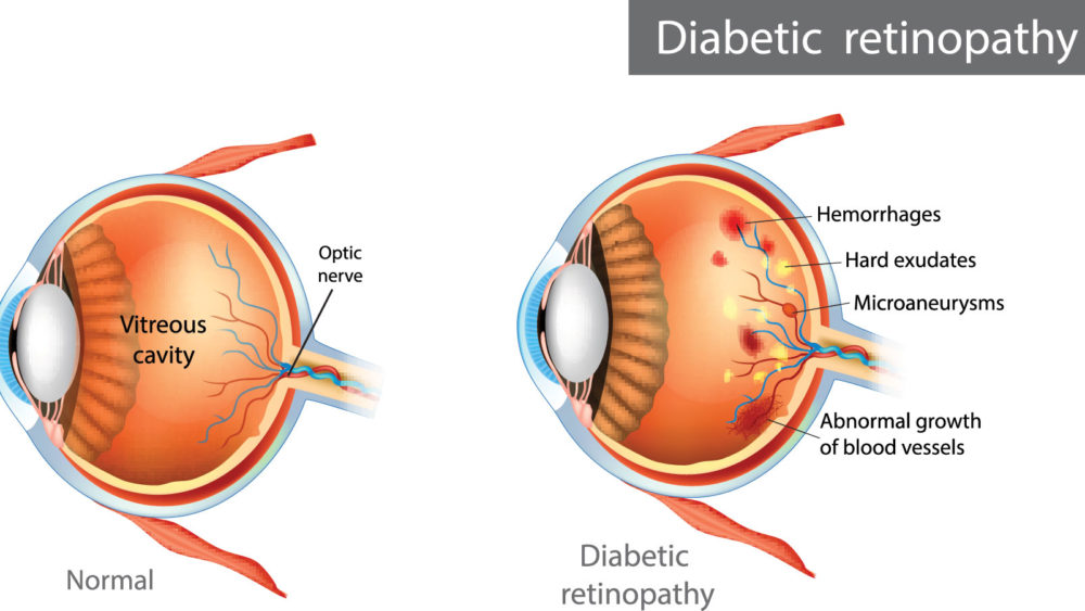 Damaged blood vessels in the retina due to diabetic retinopathy. Image courtesy of Prevent Blindness Optics Suppliers Pennsylvania.